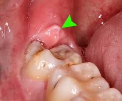 7 Tips to Avoid Problems after Wisdom Tooth Removal