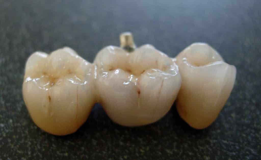 Dental Porcelain - Pain Free Dental Clinic