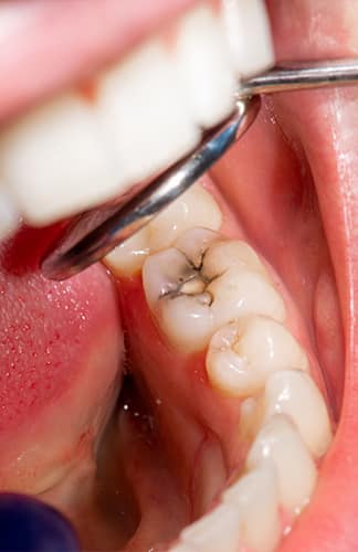 Restoration Of Tooth With Photopolymer Filling — Pain Free Dental Clinic In Moss Vale, NSW