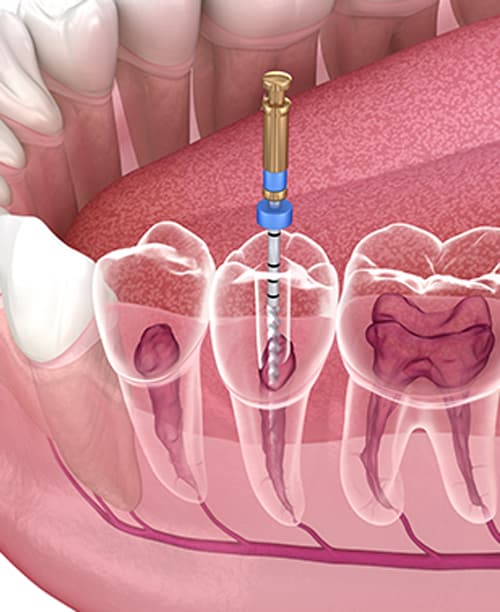 Endodontic Root Canal Treatment Process — Pain Free Dental Clinic In Moss Vale, NSW