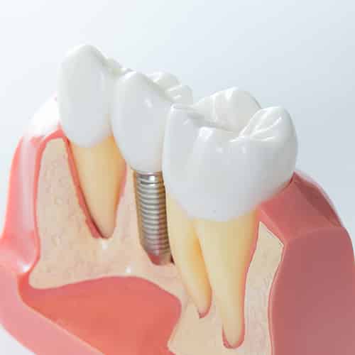 Close Up Of A Dental Implant Model — Pain Free Dental Clinic In Moss Vale, NSW