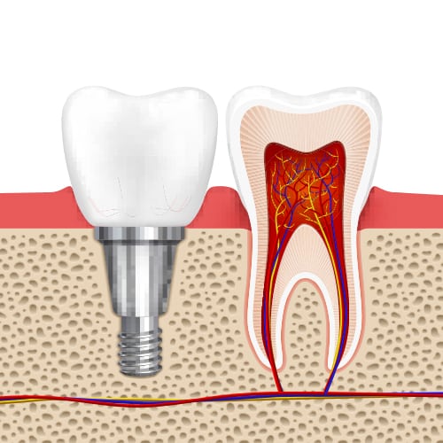 Healthy Teeth And Dental Implant — Pain Free Dental Clinic In Moss Vale, NSW