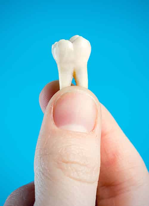White Molar Tooth — Pain Free Dental Clinic In Moss Vale, NSW