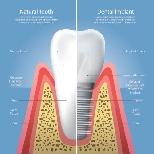 Dental Implant Cross Section Illustration