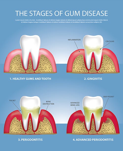 Stages of Gum Disease — Pain Free Dental Clinic In Moss Vale, NSW