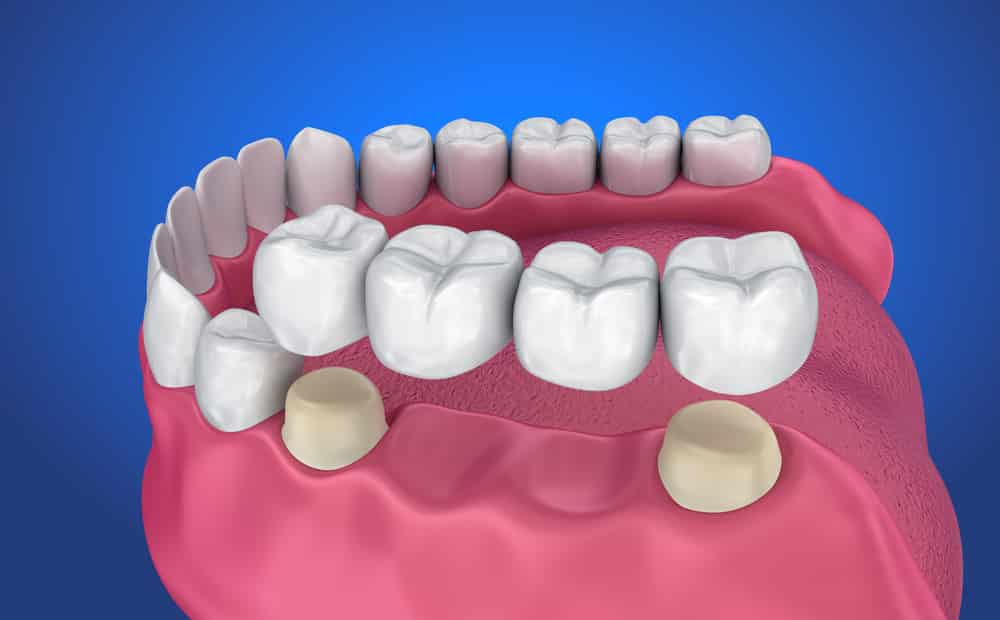 Dental bridge illustration