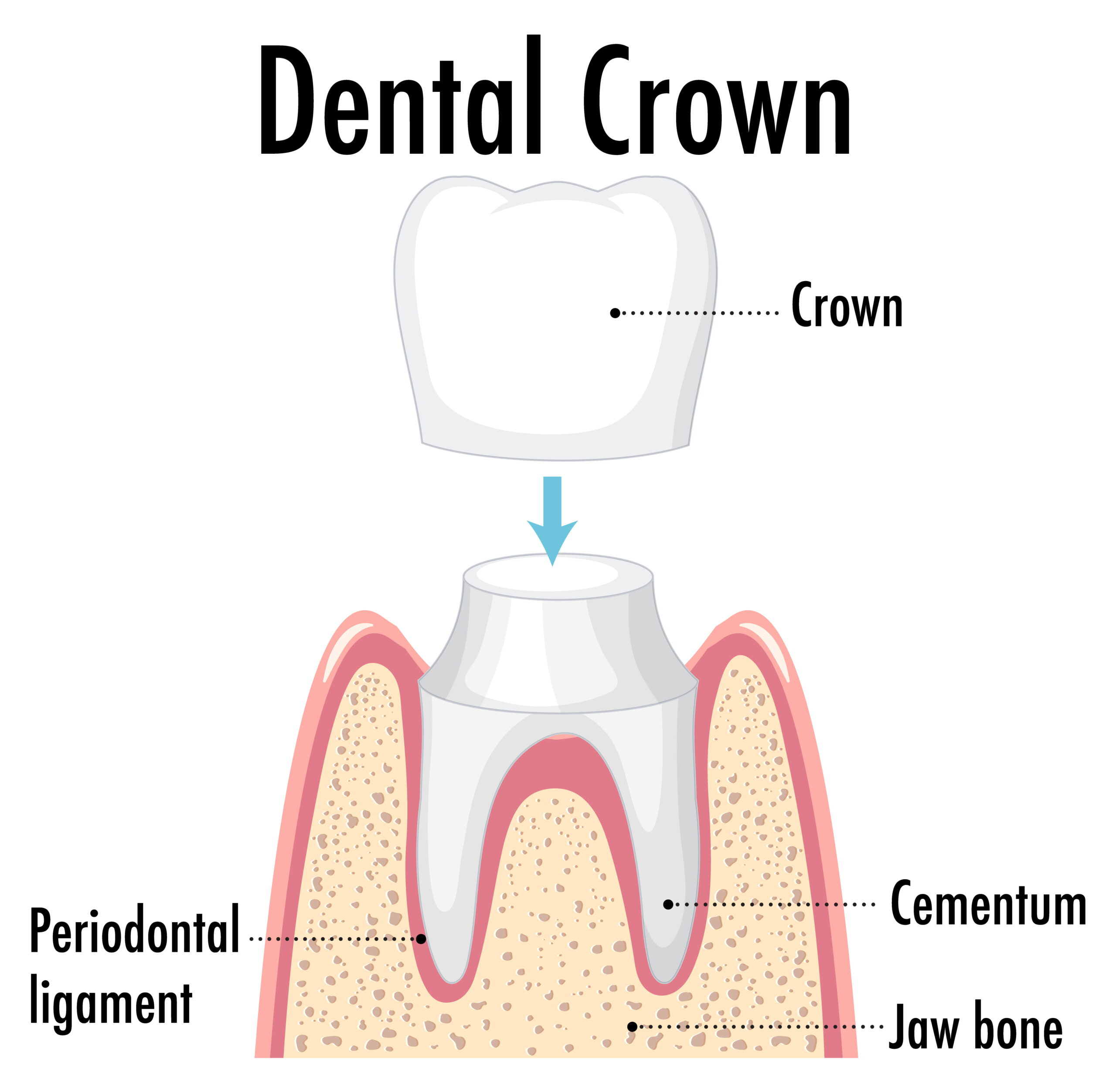 Do Dental Crown Ever Need To Be Replaced | Pain Free Dental Clinic Do Dental Crown Ever Need To Be Replaced