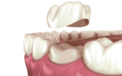 Dental Implants vs Dental Bridge: What’s the Difference