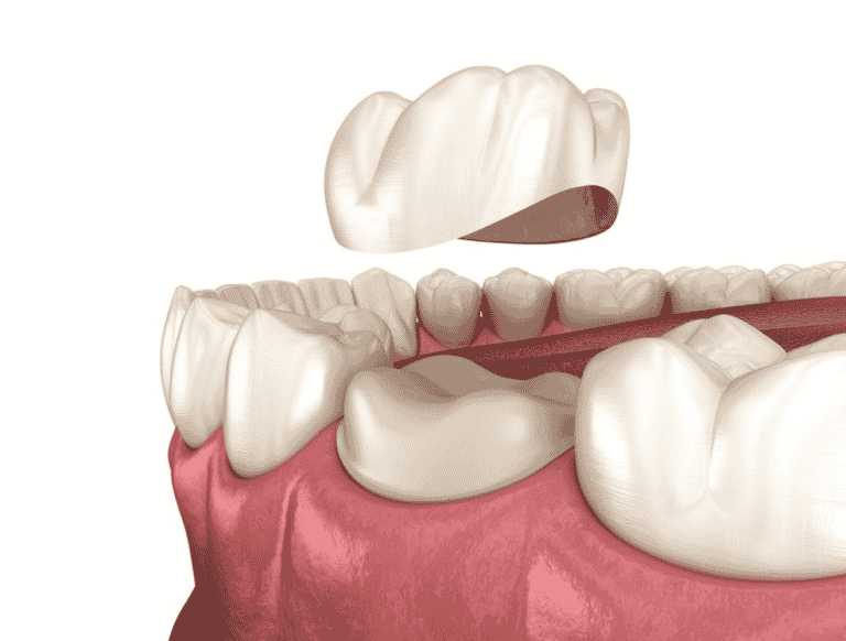 Dental Crown Replacement For Molar Tooth