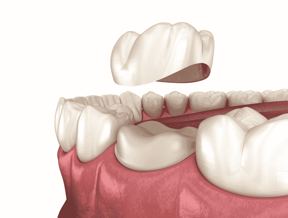 Dental Crown Replacement For Molar Tooth Dental Crown Replacement For Molar Tooth