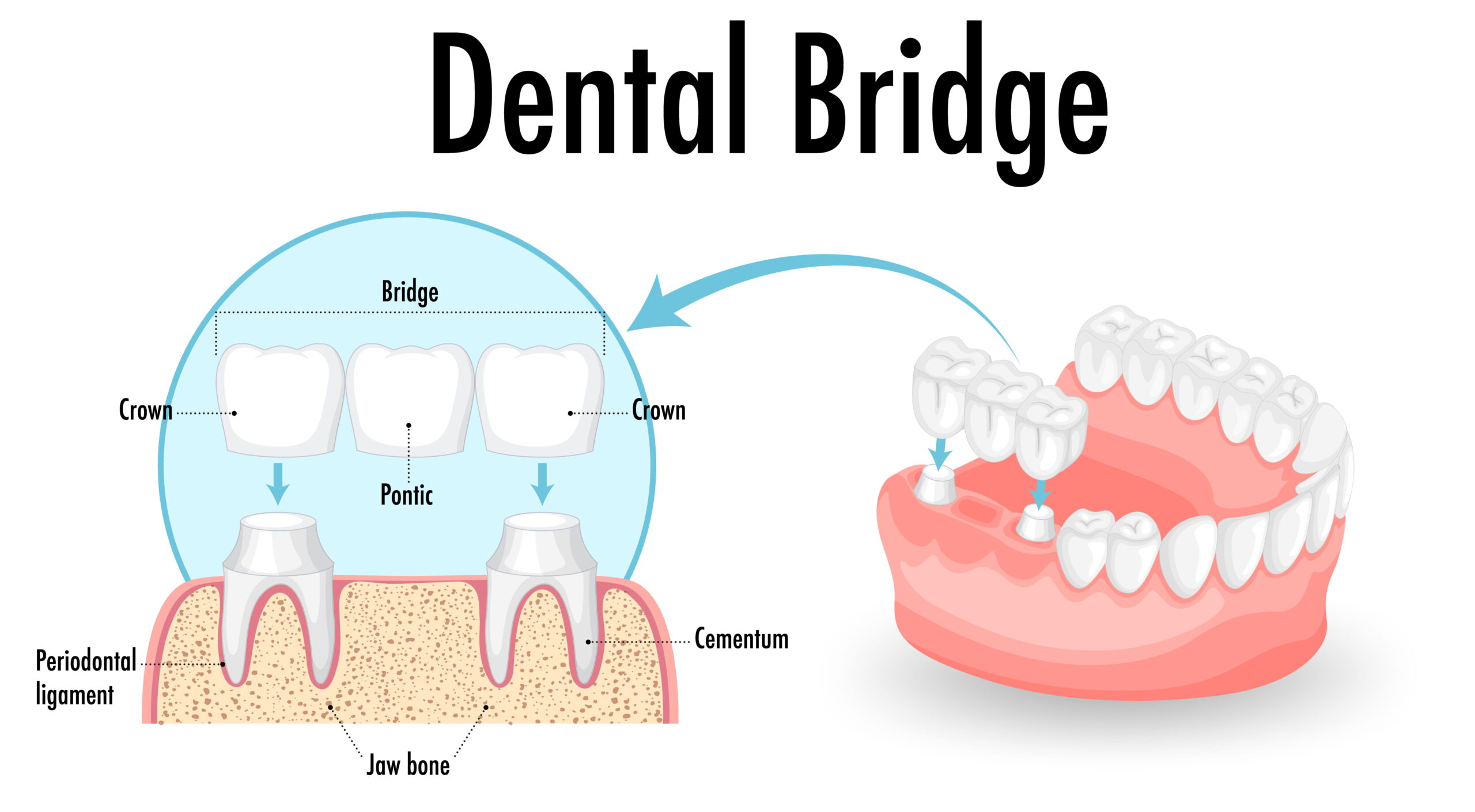 Dental Implants vs Dental Bridge Whats the Difference | Pain Free Dental Clinic Dental Implants vs Dental Bridge What's the Difference