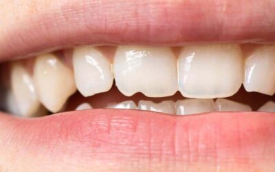 How Does A Dentist Fix A Chipped Tooth?