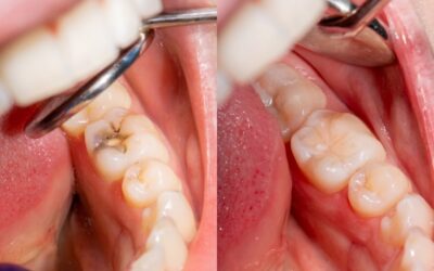 How Long Do Fillings Last?
