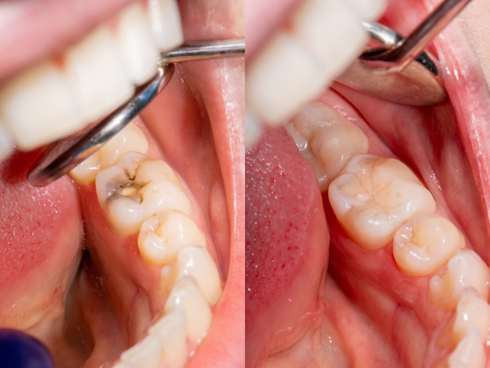 Before And After Dental Filling