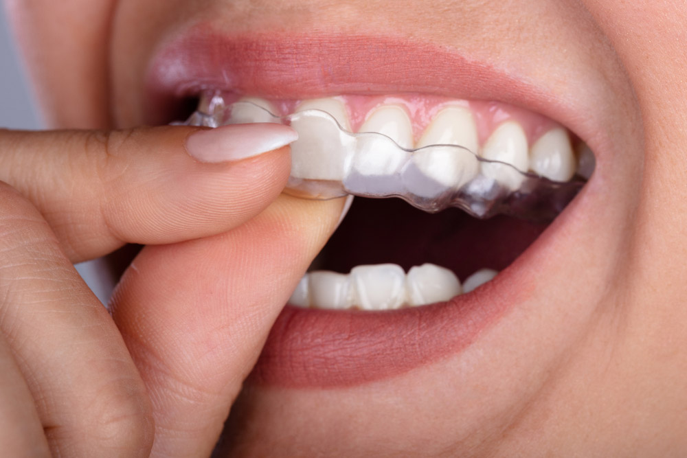 Woman Using Clear Aligners