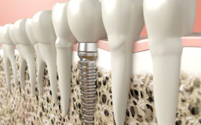 Bone Graft For Dental Implant