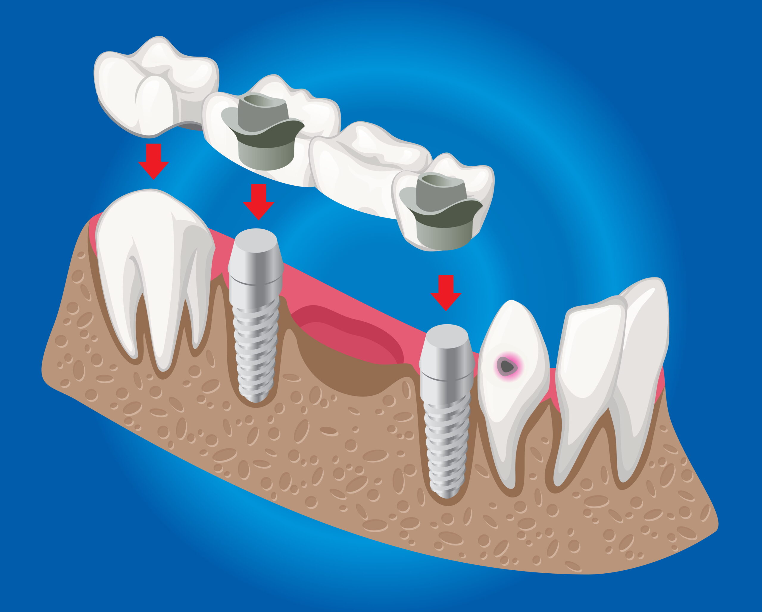 Bone Graft For Dental Implant | Pain Free Dental Clinic Bone Graft For Dental Implant