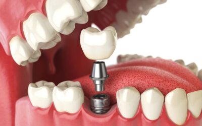 Practical Tips For Long-lasting Implant Success