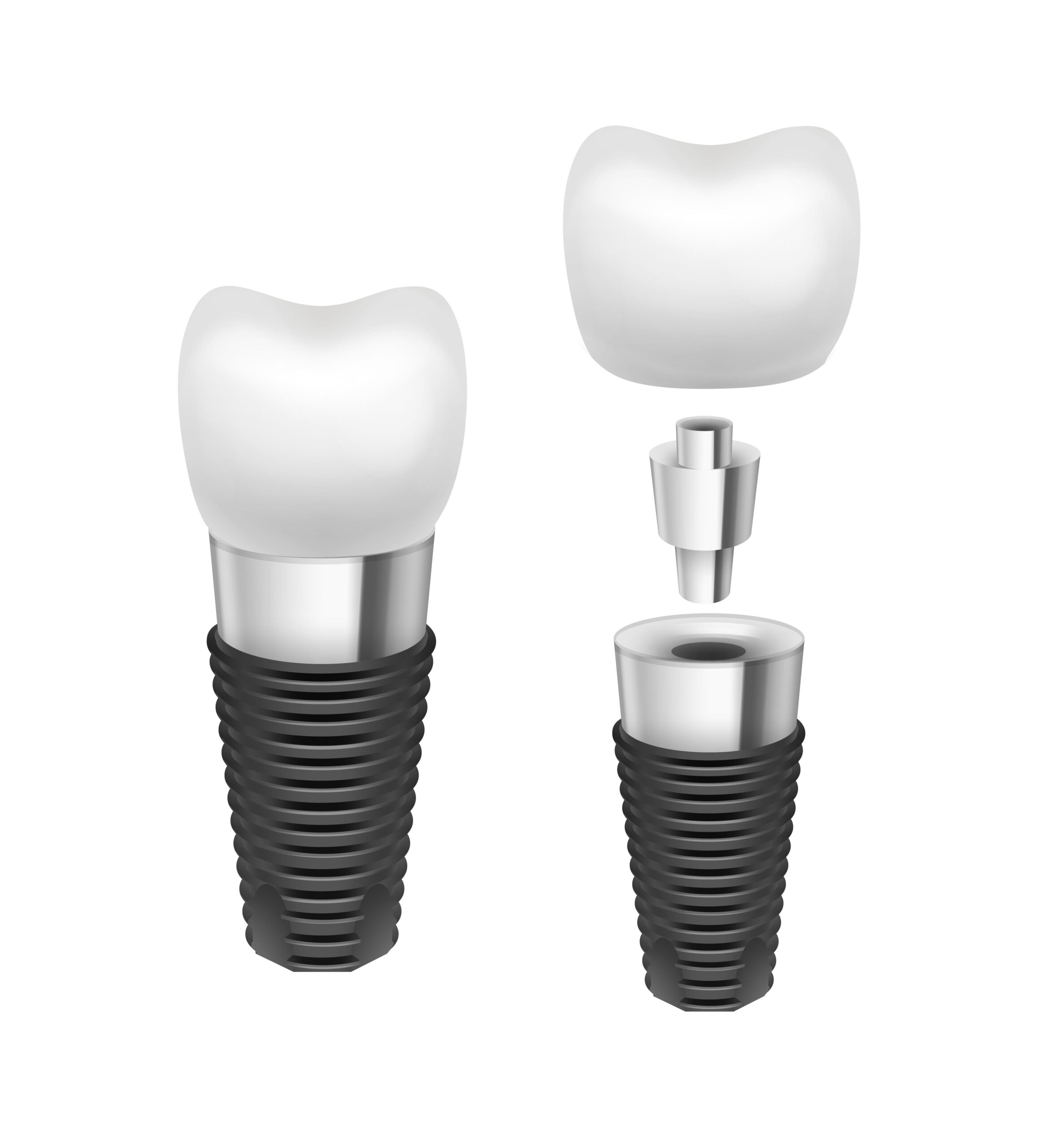 Practical Tips For Longlasting Implant Success | Pain Free Dental Clinic Practical Tips For Long lasting Implant Success