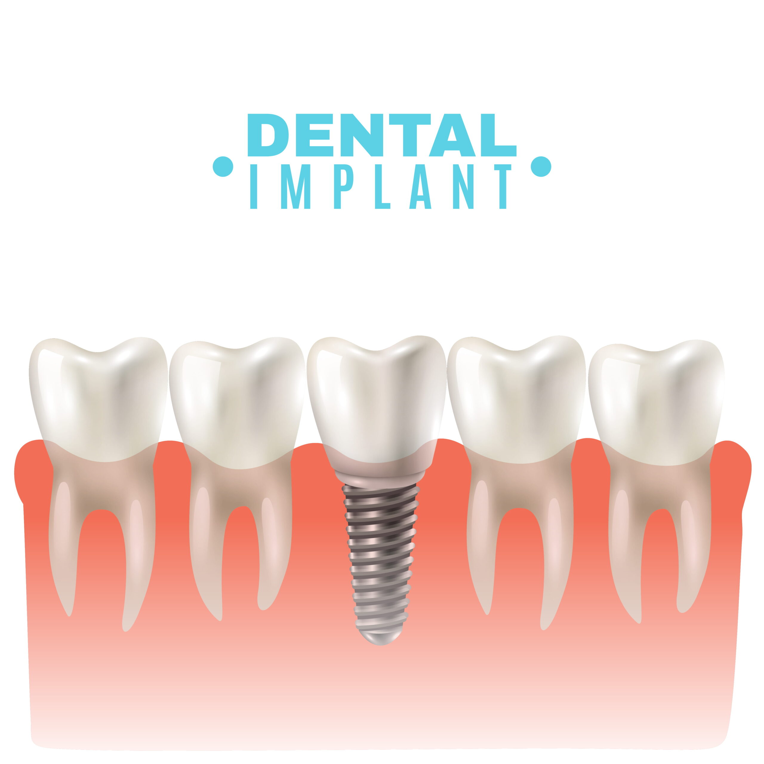 4 Myths Dental Implants Debunked | Pain Free Dental Clinic 4 Myths Dental Implants Debunked