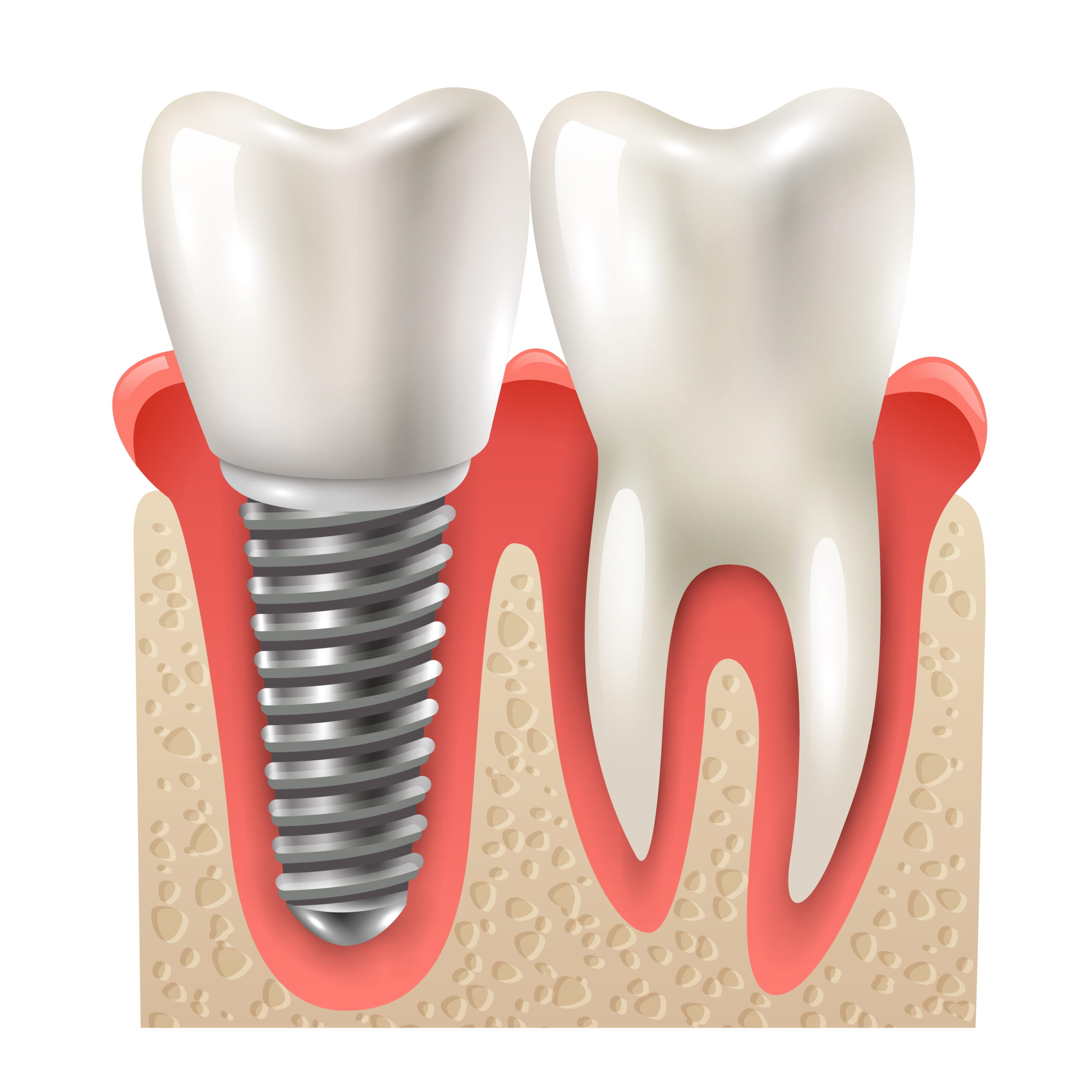 Dental Implant Surgery Tips For Maintaining Oral Health | Pain Free Dental Clinic Dental Implant Surgery Tips For Maintaining Oral Health