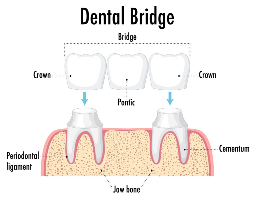 A Comprehensive Guide To The Different Types Of Dental Bridges | Pain Free Dental Clinic A Comprehensive Guide To The Different Types Of Dental Bridges