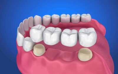Dental Bridges: A Comprehensive Guide To The Different Types