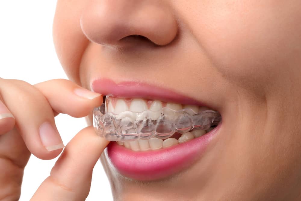 Straight Teeth Without The Metal