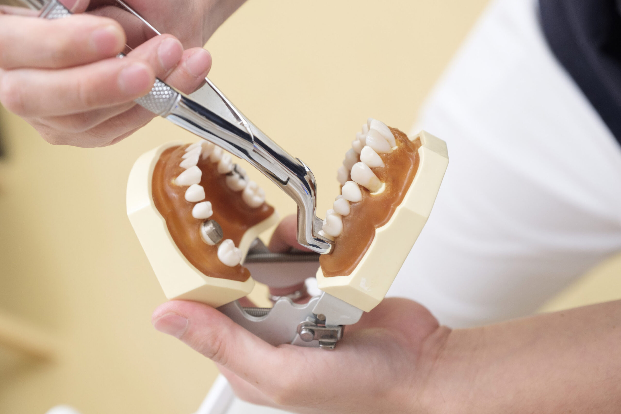 Why is tooth extraction required