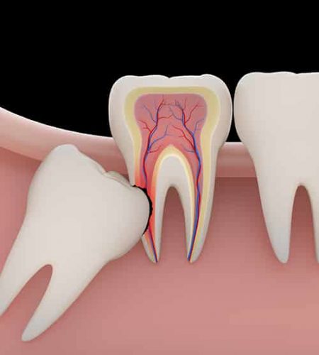 3D Wisdom Teeth Sample — Pain Free Dental Clinic In Moss Vale, NSW